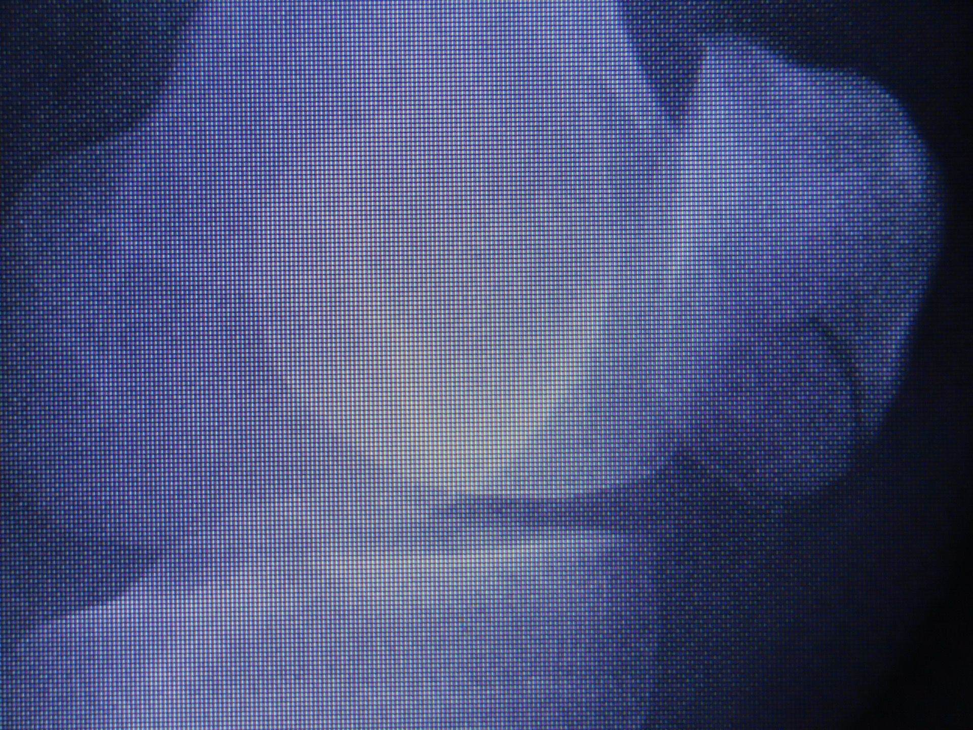 膝蓋骨骨折（膝のお皿の骨折）